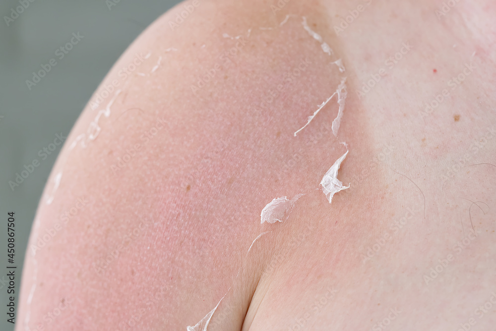 Fototapeta premium Sunburned skin on a man's body. Skin care and UV protection concept. Skin comes off with the man body after sunburn