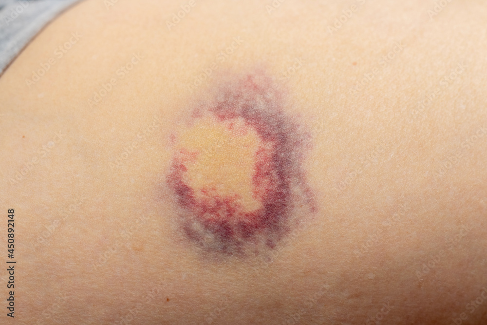 Fototapeta premium Hematoma on a woman's body as a result of violence
