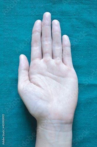 Pale palmar surface of hand. Anaemic hand of Asian man. photo
