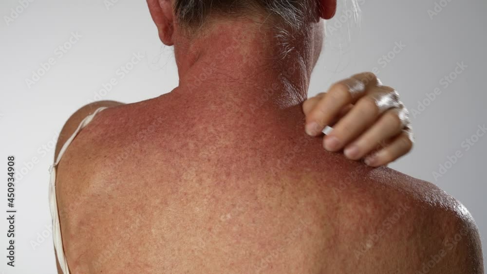 Woman scratching dry flaky skin on hand with psoriasis, eczema and other skin conditions like fungus, plaque, rash and patches. Autoimmune genetic disease. Woman scratching dry flaky skin on hand with psoriasis, eczema and other skin conditions like fungus, plaque, rash and patches. Autoimmune genetic disease.