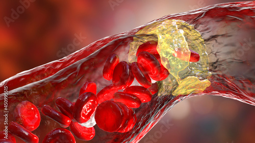 Atherosclerosis, atheromatous plaque inside artery photo