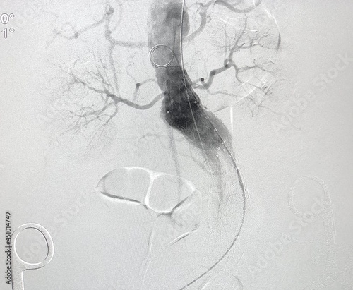 Angiogram of aorta shown Infra-renal abdominal aortic aneurysm (AAA) during endovascular aortic aneurysm repair (EVAR) procedure. photo