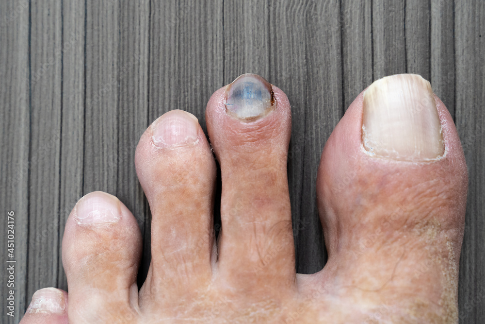 Naklejka premium Black dark toenail peeling from toe and bleeding after wearing small, tight shoes. Close up of pain. I need an operation for treatment