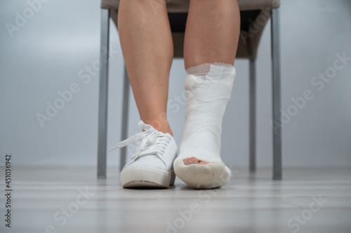 Close-up of female legs with plaster cast. A woman with a broken leg sits on a chair
