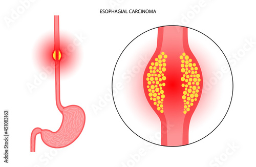 esophageal cancer concept