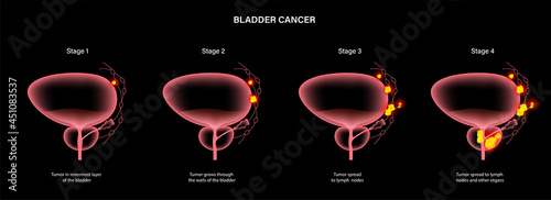 Bladder cancer stages