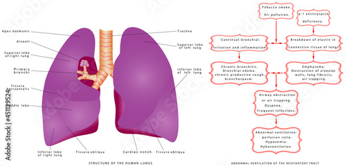 Respiratory Tract Disorders. Respiration and Health. Upper (Sinusitis, Otitis Media, Tonsillitis, Laryngitis) & Lower (Acute bronchitis, Pneumonia, Pulmonary tuberculosis) Respiratory Tract Infections