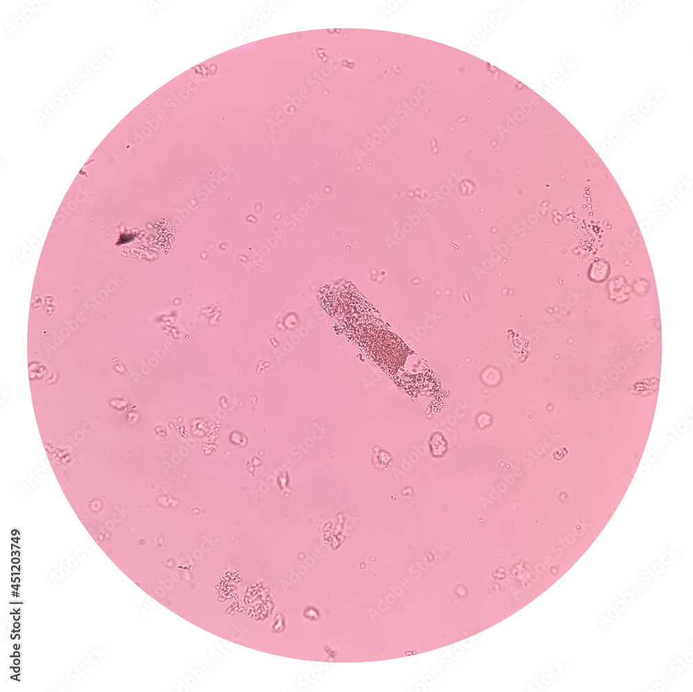 Urinary sediment microscopy is the presence of granular casts. Casts are  clusters of urinary sediment elements wrapped in a protein matrix. Stock  Photo | Adobe Stock