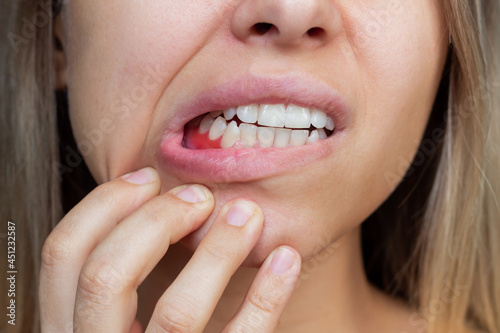Gum inflammation. Close-up of a young woman showing bleeding gums. Dentistry, dental care