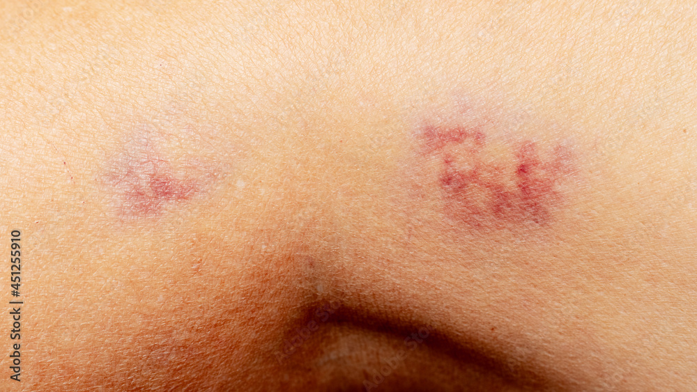 Fototapeta premium Two hematomas on the leg in a woman. Domestic violence