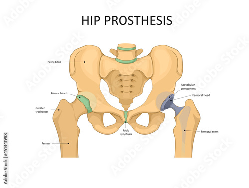 Hip replacement implant installed in the pelvis bone. Medical vector illustration