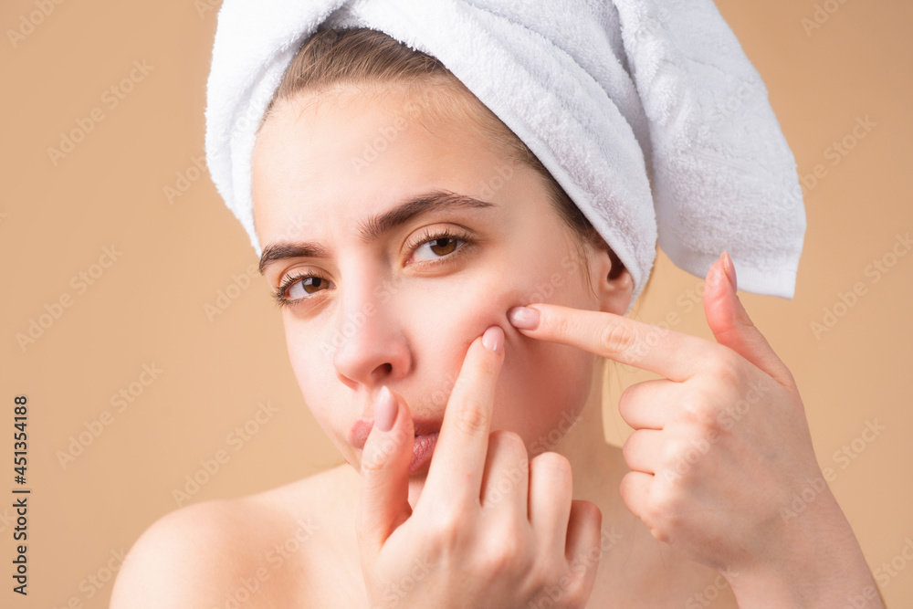 Close up beautiful girl squeezing pimples on her face. Acne blemish spots skin on young woman. Spot scar acne, freckles, and melasma pigmentation skin facial treatment, problem skin concept.