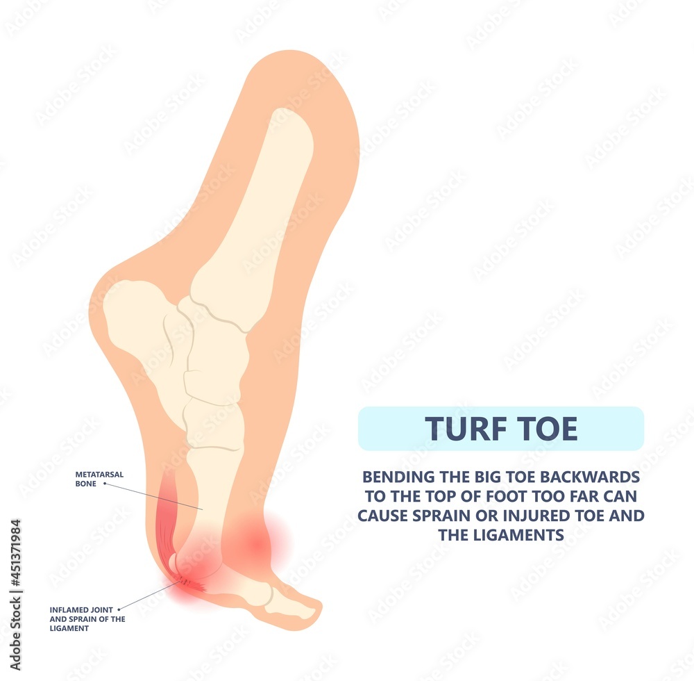 Poster Turf Toe Gout Torn Tear Broken Bone Big Joint Sprain Sport Foot 
