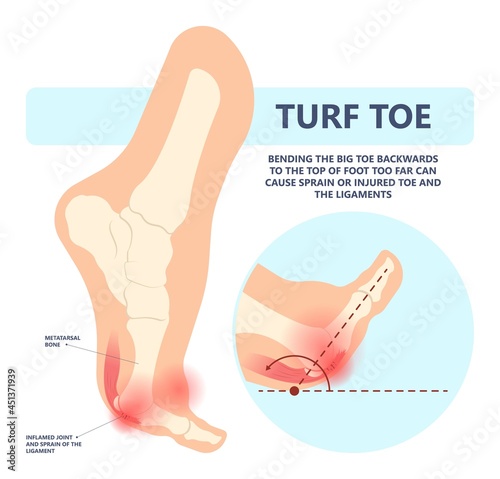 turf toe gout torn tear broken bone big joint sprain sport foot distal pain trauma range of motion bend ankle tendon ball lesser flexor brevis plate bent treat first Aid heal Inflamed deformity stiff