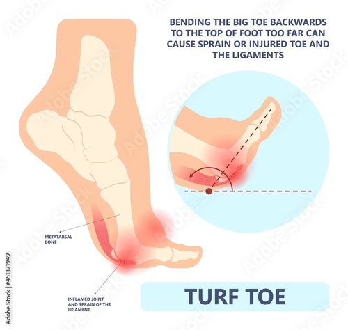 turf toe gout torn tear broken bone big joint sprain sport foot distal pain trauma range of motion bend ankle tendon ball lesser flexor brevis plate bent treat first Aid heal Inflamed deformity stiff