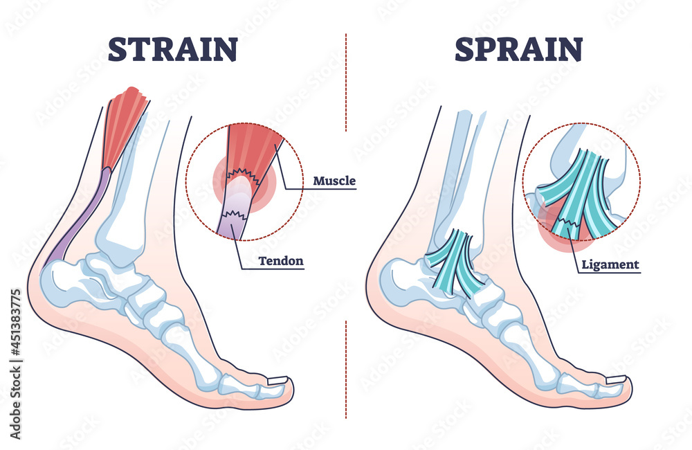 Sprain vs strain anatomical comparison as medical foot injury outline diagram. Labeled educational orthopedic muscle, tendon and ligament problem description vector illustration. Painful foot twist. - obrazy, fototapety, plakaty 