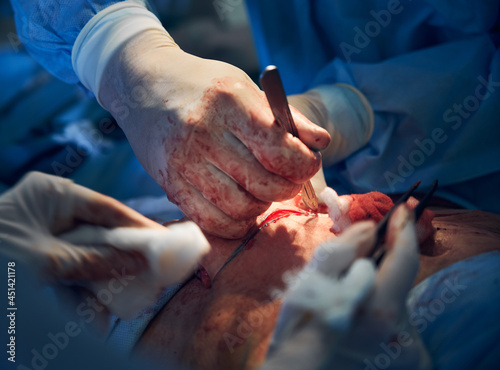 Close up of doctor hands in sterile gloves cutting excess skin with scalpel while performing abdominoplasty surgery, removing extra fat and skin from patient belly during abdominal plastic surgery.
