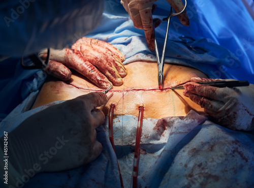 Close up of medical workers hands stitching up wound after tummy tuck surgery. Plastic surgeon placing sutures while assistant using medical instruments. Concept of abdominoplasty and cosmetic surgery photo