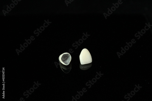Dental PFM crown and bridge with all porcelain baked for new smile . Patient's teeth.