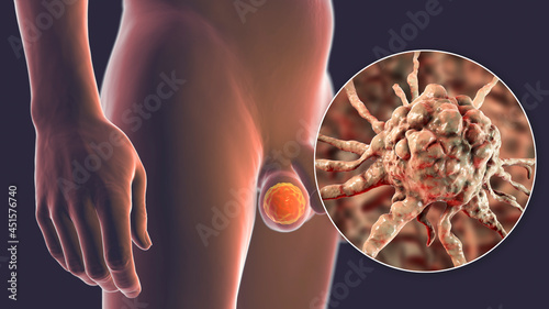 Foto Testicular cancer, 3D illustration