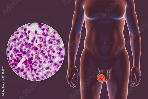 Testicular cancer, 3D illustration photo