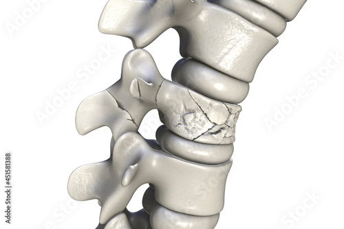Valokuva Spinal fracture, traumatic vertebral injury, illustration