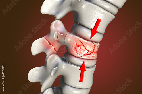 Fotografija Spinal fracture, traumatic vertebral injury, illustration