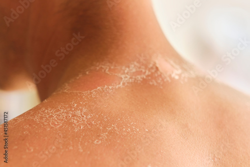 Obraz na plátně unrecognizable guy got sunburn and got tan lines on his back
