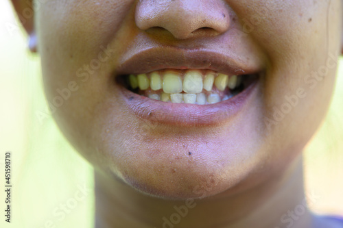 Smiling woman.Open mouth. See teeth.See teeth that are not aligned.Unattractive smile