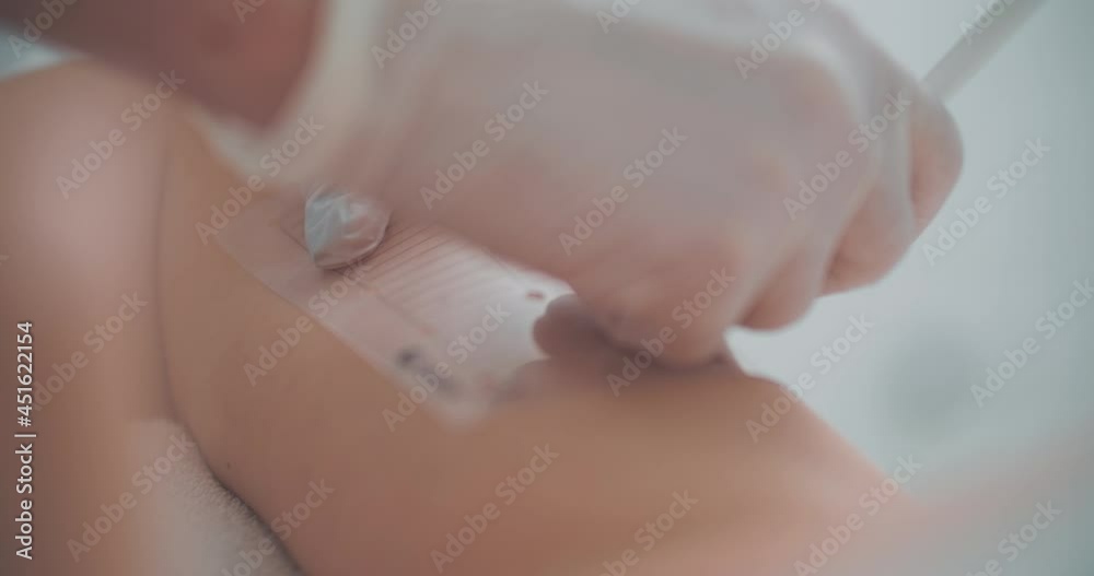 A cosmetologist is using a cosmetic pencil and stencil for painting white dods on the arm of a female client before the procedure.
