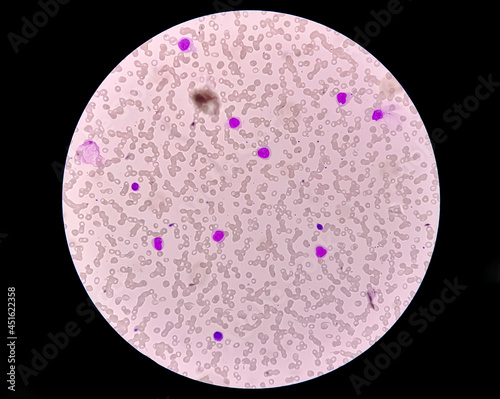 Blood picture of acute myeloid leukemia (AML), analyze by microscope
