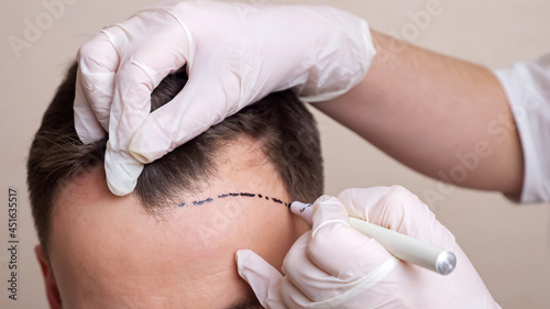 Obraz na płótnie medical professional with gloves draws a dotted line on the head of a balding man