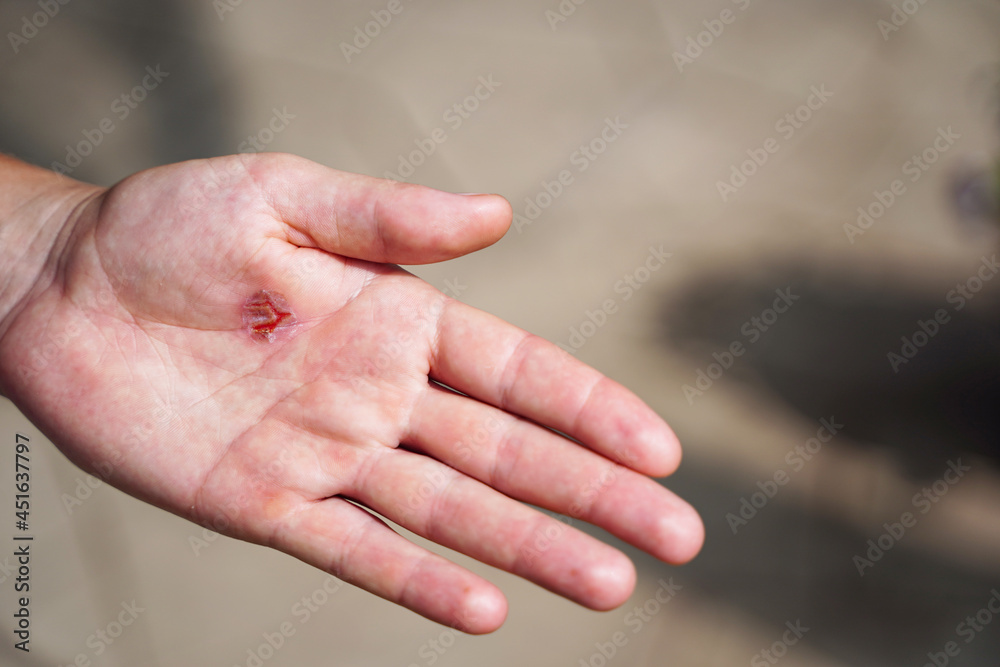 Torn callus of the hand close-up. Rough skin of male hand. Torn callus of the hand close-up. Rough skin of male hand.