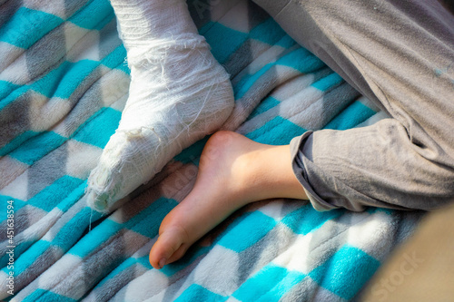 Child with bandage on leg heel fracture. Broken right foot, bone, calf, ankle, leg in plaster, splint of toddler. Little boy sleeping on a blue blanket. Human healthcare and medicine concept