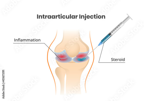 Knee joint injection. Injection of the corticosteroids scientific illustration