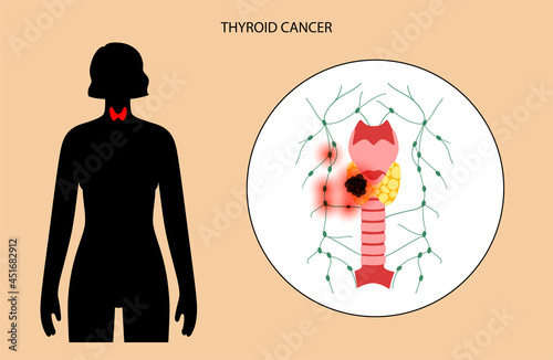 Thyroid cancer stages