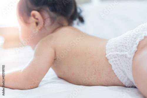 Bilde på lerret baby rash skin, prickly heat on baby (selective focus)
