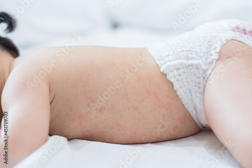 Bilde på lerret baby rash skin, prickly heat on baby (selective focus)