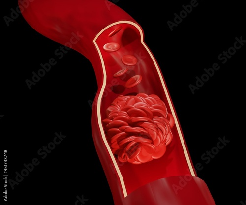 blood clot or thrombus  is the final product of the blood coagulation step in hemostasis photo