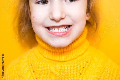 Girl shows her teeth-pathological bite, malocclusion, overbite. Pediatric dentistry and periodontics, bite correction. Health and care of teeth, caries treatment, baby teeth. Upper jaw rests on gum. photo