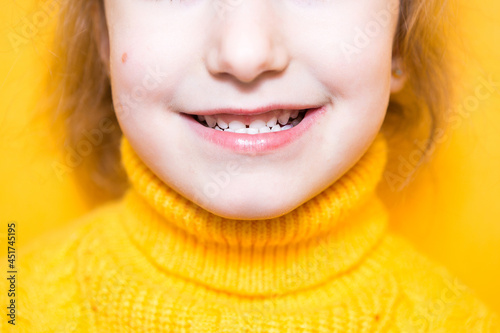 Girl shows her teeth-pathological bite, malocclusion, overbite. Pediatric dentistry and periodontics, bite correction. Health and care of teeth, caries treatment, baby teeth. Upper jaw rests on gum. photo