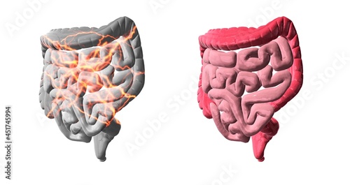 Healthy and unhealthy intestines, conceptual illustration photo