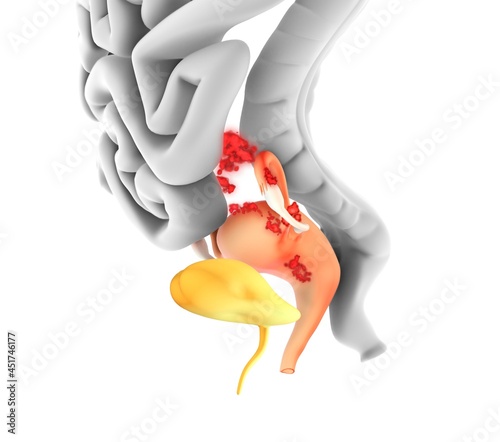 Endometriosis, illustration photo