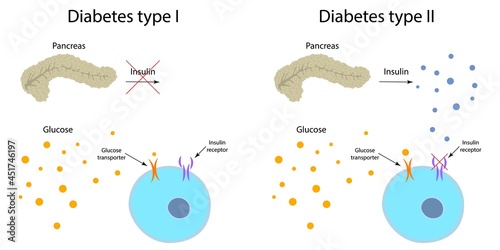 Diabetes type 1 and 2, illustration photo