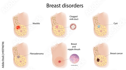 Female breast disorders, illustration photo