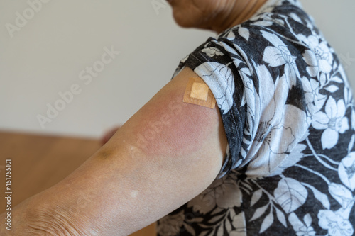 新型コロナウイルス(COVID-19)のワクチン接種を受けた後、副作用で注射した左腕が赤く腫れた高齢者女性