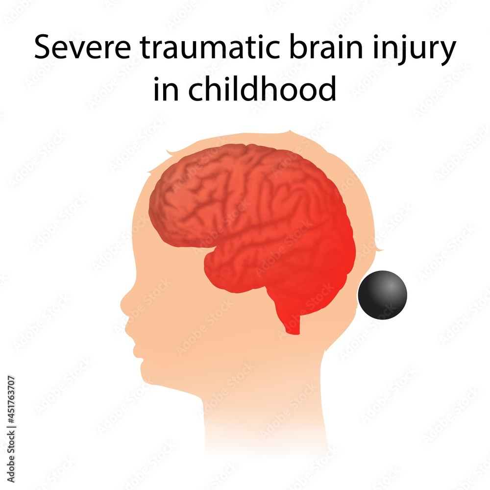 Severe traumatic brain injury in childhood, illustration Severe traumatic brain injury in childhood, illustration