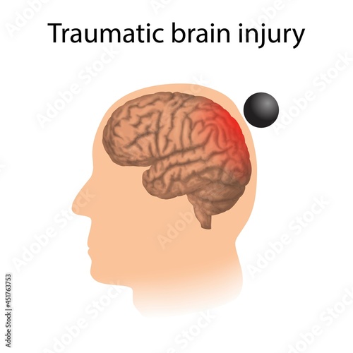 Traumatic brain injury, illustration photo