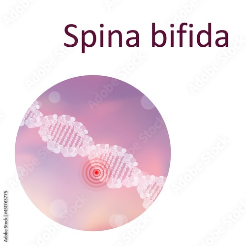 Spina bifida, illustration photo