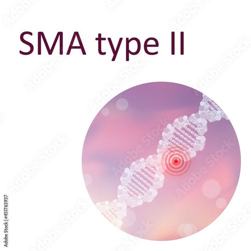 Spinal muscular atrophy type II, illustration